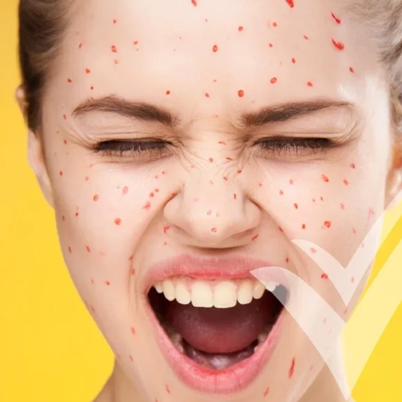 Pimples: How Long Do They Last And How Can You Manage Them?