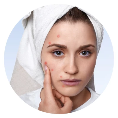 البشرة المعرضة للحب